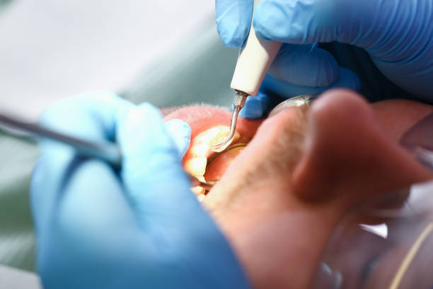 Best Emergency Root Canal Treatment in Forest Hills, MI